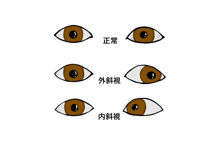 斜視の画像
